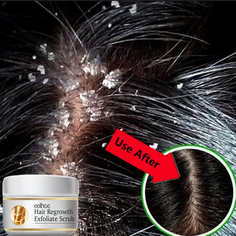 Snelle Anti-roos Haarbehandeli - Scalp Scrub Exfoliant recensie en prijs