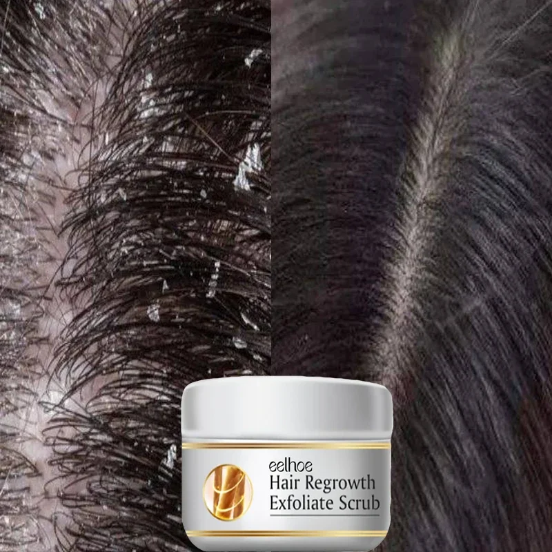 Snelle Anti-roos Haarbehandeli - Scalp Scrub Exfoliant recensie en prijs